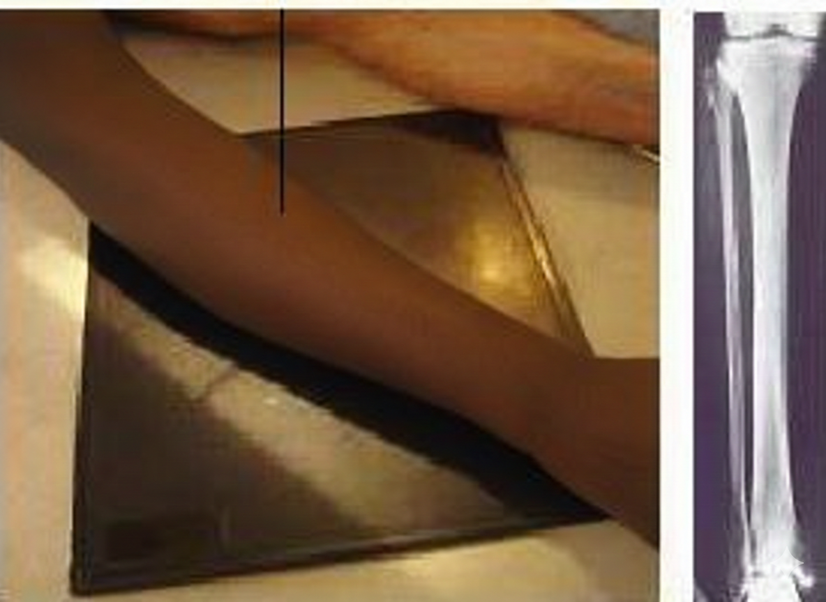 Proyección AP Pierna